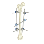 Stryker External Fixation System Orthopedics Modular external Fixator Set